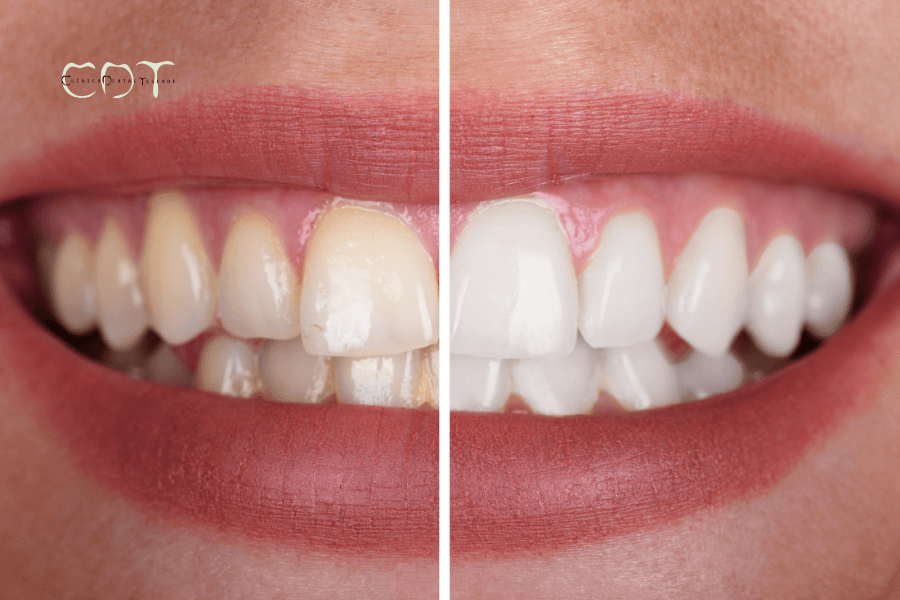 comparativa antes y despues blanqueamiento dental